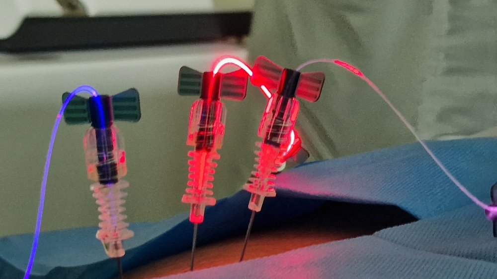  Spinal Injury Treatment with Laser and Advanced PRP
